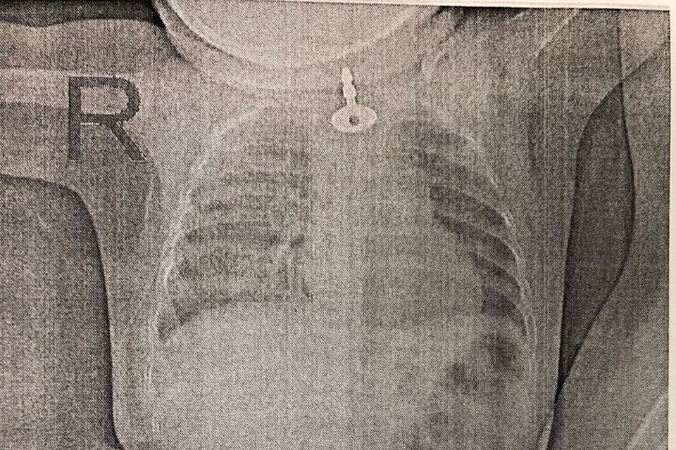 Ключ в пищеводе увидели на рентгене. Фото: instagram.com/dr._shaginian