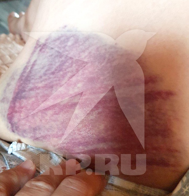 Повреждения на теле Марины.